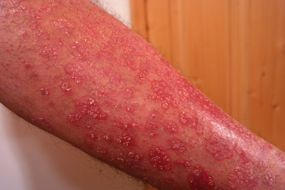 Scaly skin inflammatory skin disease