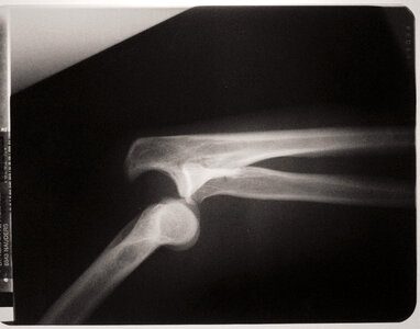 X-Ray With Dislocated Arm Joints photo