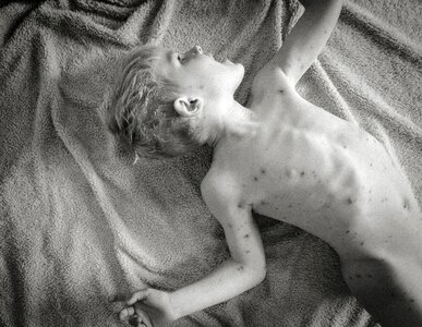 Free stock photo of chicken pox