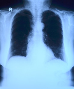 Thorax lung x-ray medical photo