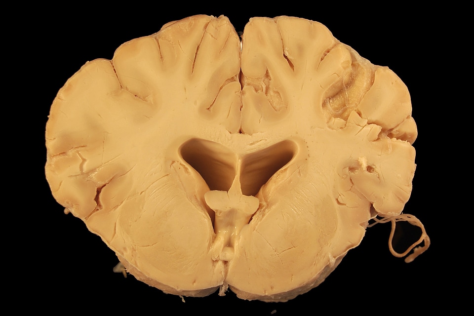 Cerebrum ventricle white matter