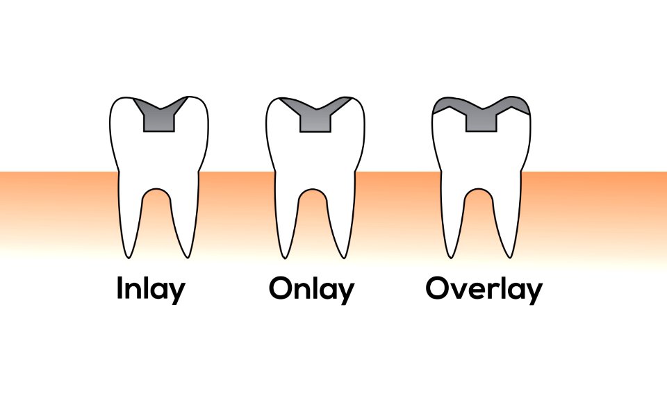 Inlay Overlay Onlay Illustration