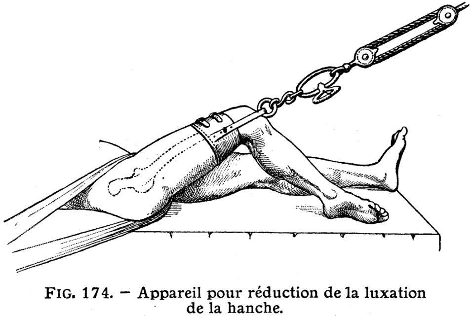 Reduction Luxation Hanche