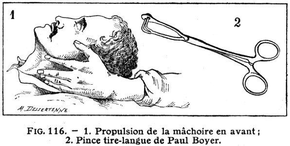 Pince Tire-langue-1