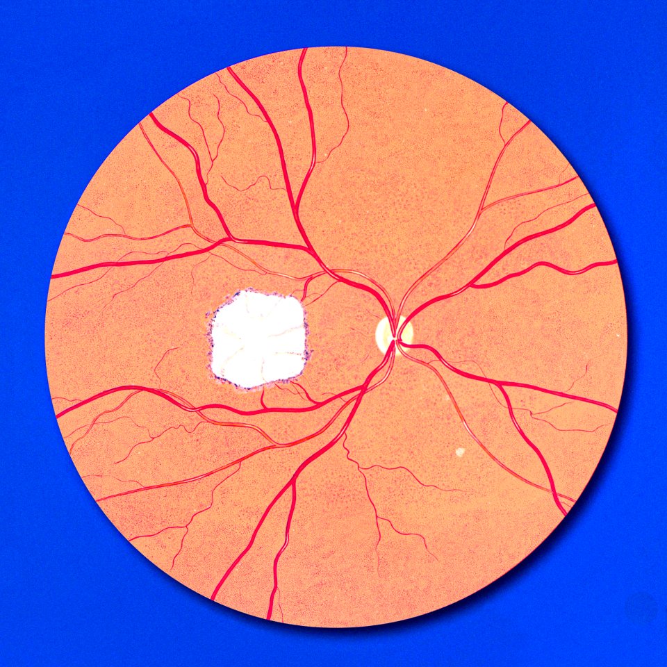 Fundoscopic view of the right eye, it's optic nerve and blood vessels supplying the retina. Original image sourced from US Government department: Public Health Image Library, Centers for Disease Control and Prevention. Under US law this image is copyright free, please credit the government department whenever you can”.