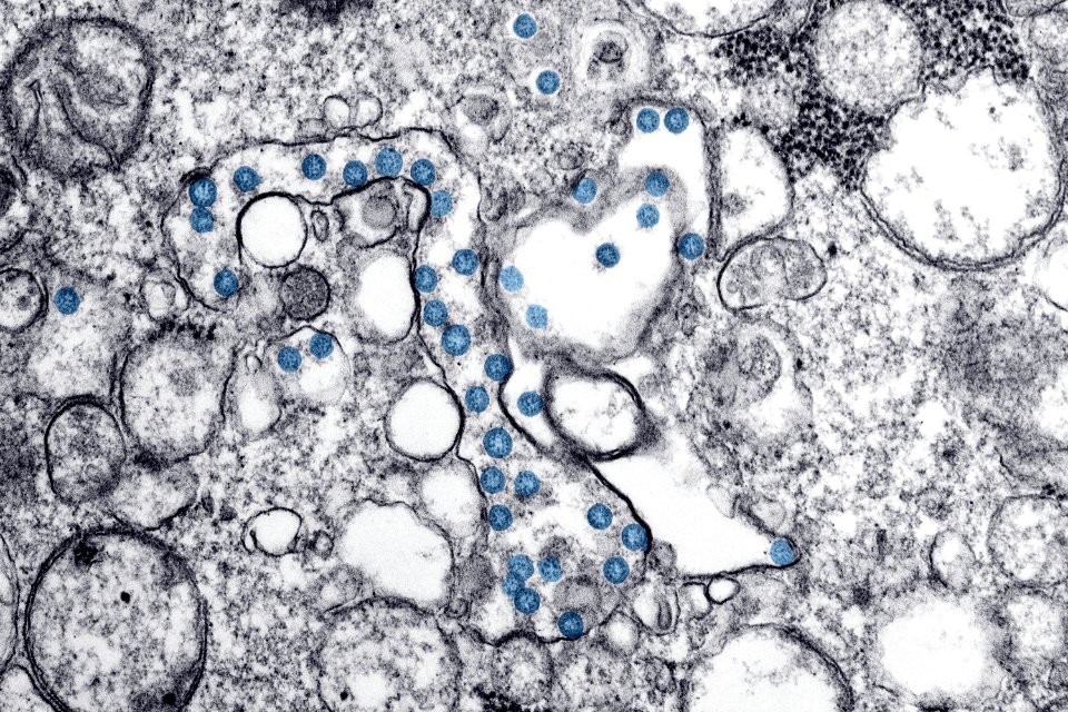 White coronavirus under a Microscope. Original image sourced from US Government department: Public Health Image Library, Centers for Disease Control and Prevention. Under US law this image is copyright free, please credit the government department whenever you can”.