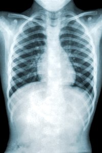 Chest x-ray of a patient with mycoplasma pneumonia. Original image sourced from US Government department: Public Health Image Library, Centers for Disease Control and Prevention. Under US law this image is copyright free, please credit the government department whenever you can”.