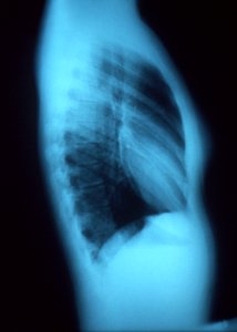 A right lateral chest x-ray of normal, healthy thoracic and pulmonary conditions. Original image sourced from US Government department: Public Health Image Library, Centers for Disease Control and Prevention. Under US law this image is copyright free, please credit the government department whenever you can”.