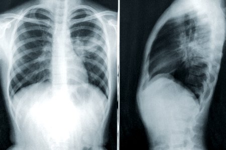 Two chest x-rays in the case of a child with a case of mycoplasma pneumonia. Original image sourced from US Government department: Public Health Image Library, Centers for Disease Control and Prevention. Under US law this image is copyright free, please credit the government department whenever you can”.