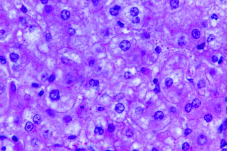 A 440X photomicrograph magnification of a hematoxylin and eosin (H&E)–stained liver tissue specimen, revealed the presence of cytoarchitectural changes indicative of fatty degeneration. Original image sourced from US Government department: Public Health Image Library, Centers for Disease Control and Prevention. Under US law this image is copyright free, please credit the government department whenever you can”.