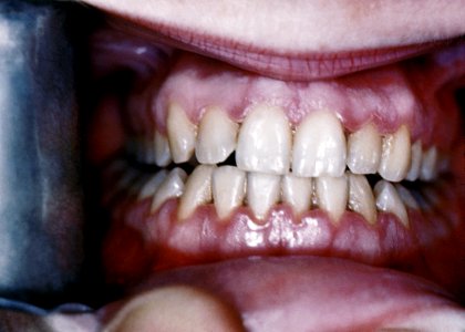 An example of acute necrotizing ulcerative gingivitis, also known as trench mouth. Original image sourced from US Government department: Public Health Image Library, Centers for Disease Control and Prevention. Under US law this image is copyright free, please credit the government department whenever you can”. photo