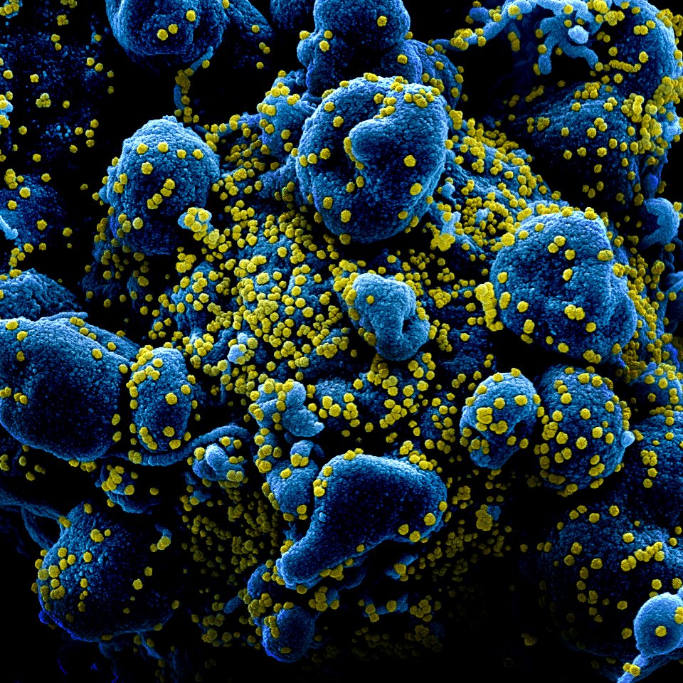 Novel Coronavirus SARS-CoV-2–Colorized scanning electron micrograph of an apoptotic cell (blue) heavily infected with SARS-COV-2 virus particles (yellow), isolated from a patient sample. Original image sourced from US Government department: The National Institute of Allergy and Infectious Diseases. Under US law this image is copyright free, please credit the government department whenever you can”.