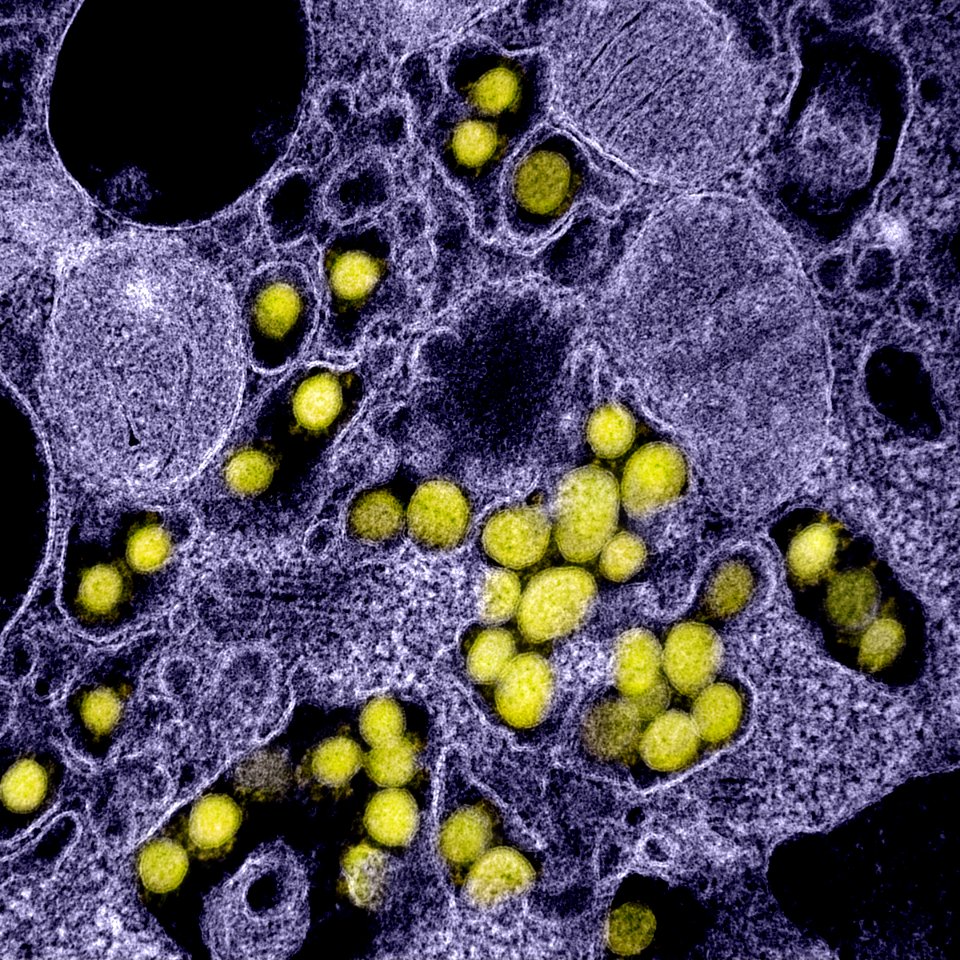 Novel Coronavirus SARS-CoV-2–Transmission electron micrograph of SARS-CoV-2 virus particles, isolated from a patient. Original image sourced from US Government department: The National Institute of Allergy and Infectious Diseases. Under US law this image is copyright free, please credit the government department whenever you can”.
