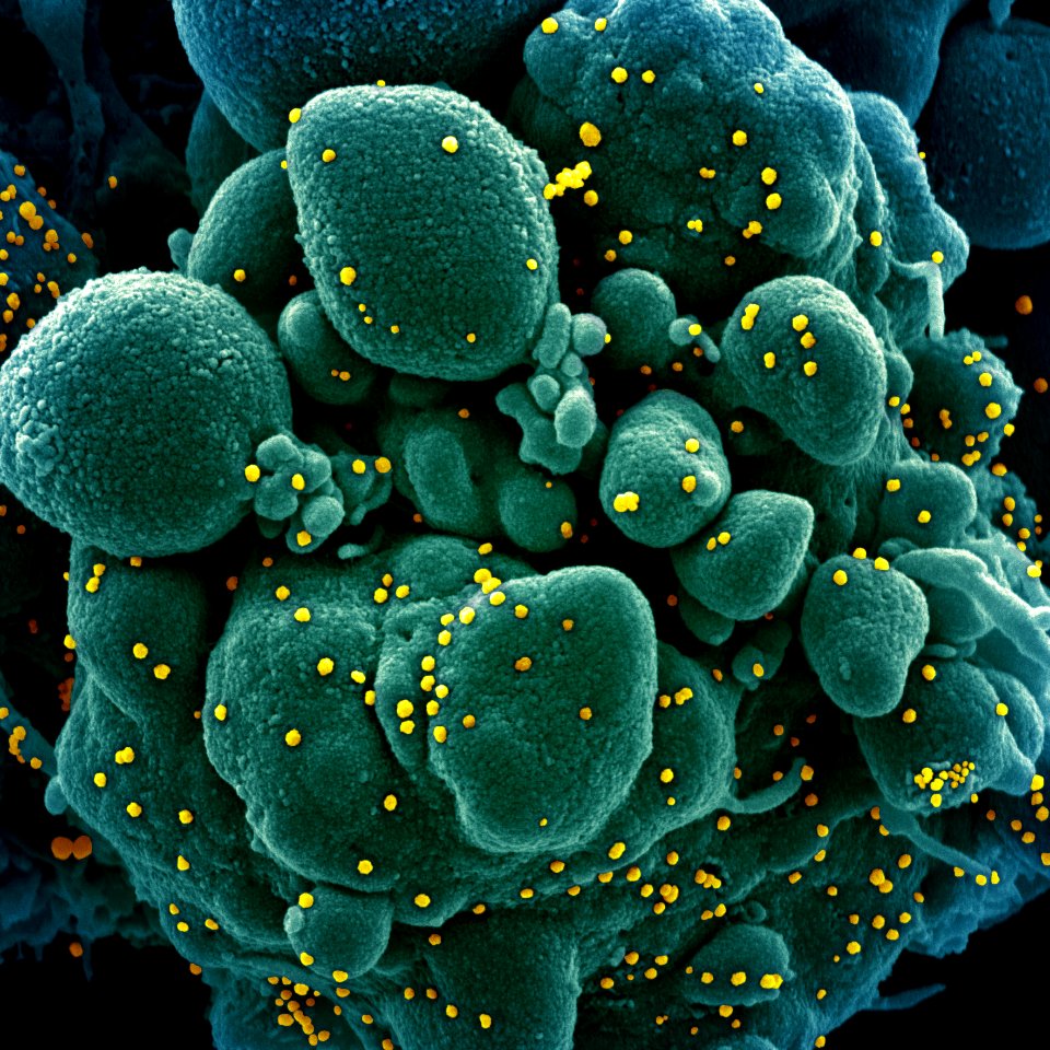 Novel Coronavirus SARS-CoV-2–Colorized scanning electron micrograph of an apoptotic cell (green) infected with SARS-COV-2 virus particles (yellow), isolated from a patient sample. Original image sourced from US Government department: The National Institute of Allergy and Infectious Diseases. Under US law this image is copyright free, please credit the government department whenever you can”.
