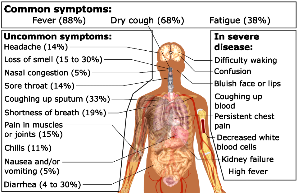 Symptoms of coronavirus disease 2019 3.0