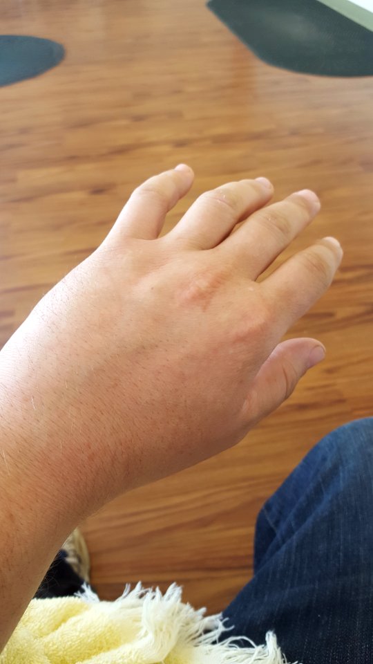 swollen hand boxing fracture