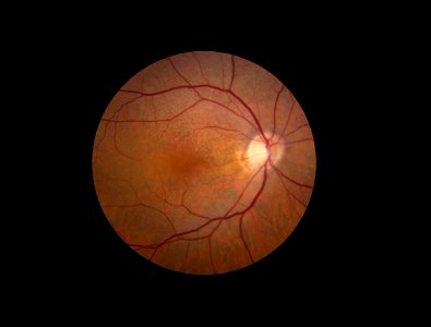 Retina showing reticular pseudodrusen photo