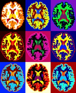 Axial MRI scans of a person with multiple sclerosis photo