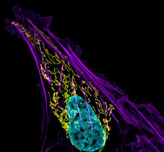 Bone cancer cell