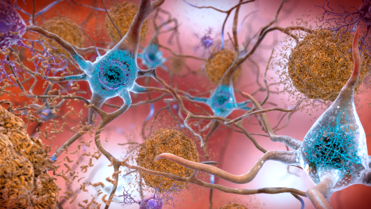 Beta-Amyloid Plaques and Tau in the Brain photo