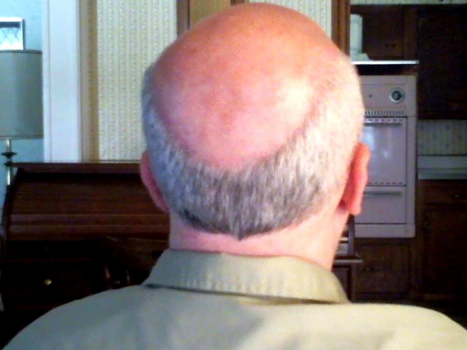 bald head and receding fringe from the rear