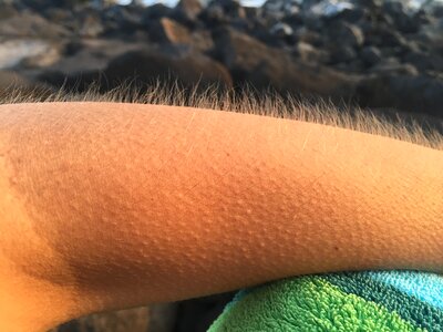 Goosebumps cold arm