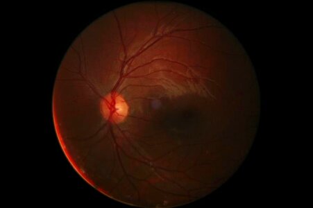 Retinal cornea eye photo