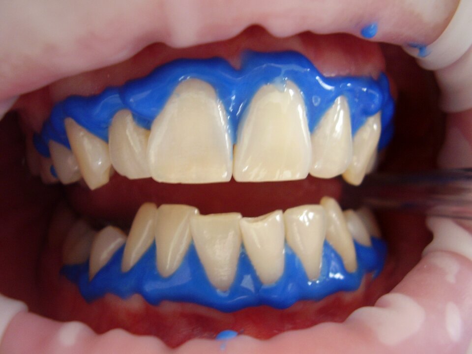 Laser treatment mouth