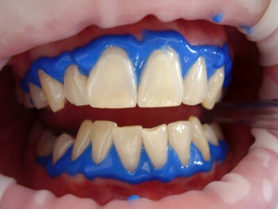 Laser treatment mouth photo