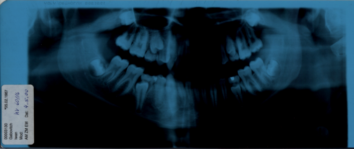 X-ray of my teeth, year 2000