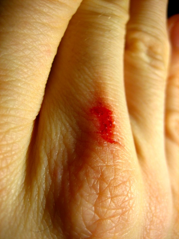 Bloody finger wound public domain