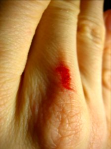 Bloody finger wound public domain photo