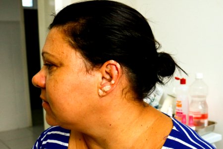 14.03.2018 - Atendimento com auriculoterapia a grupo crônico na UBS Virgílio Costa - Foto Michel Corvello