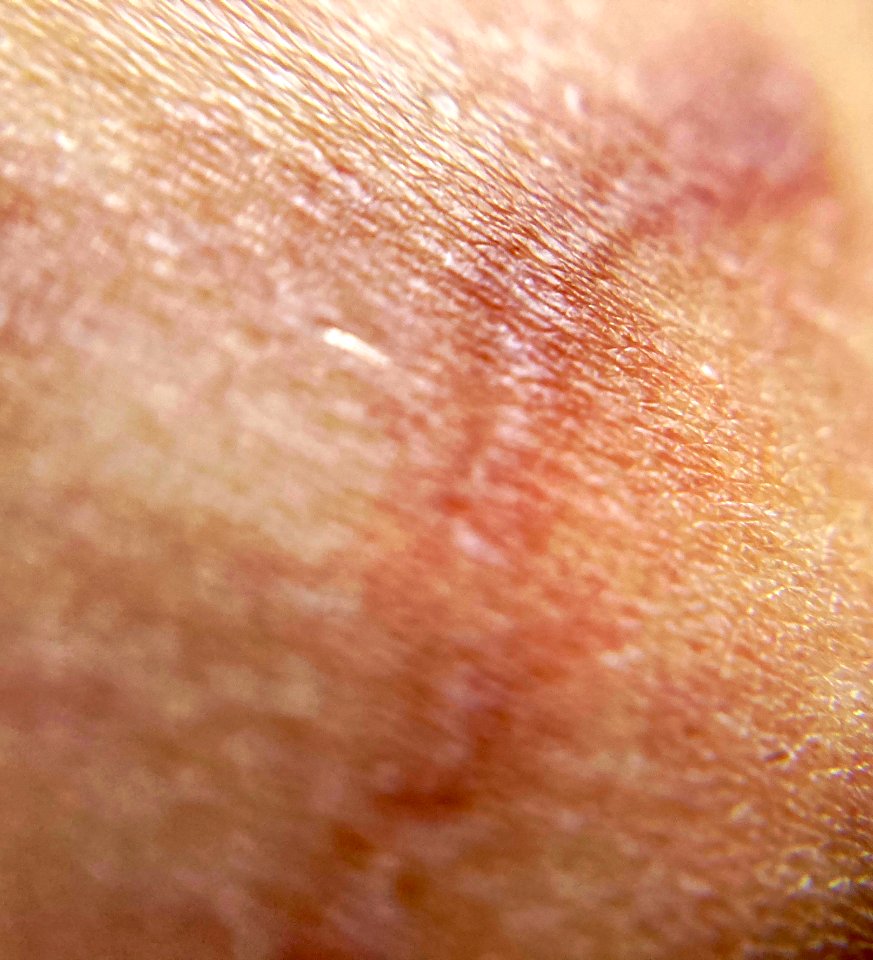 A scar