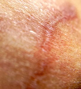 A scar