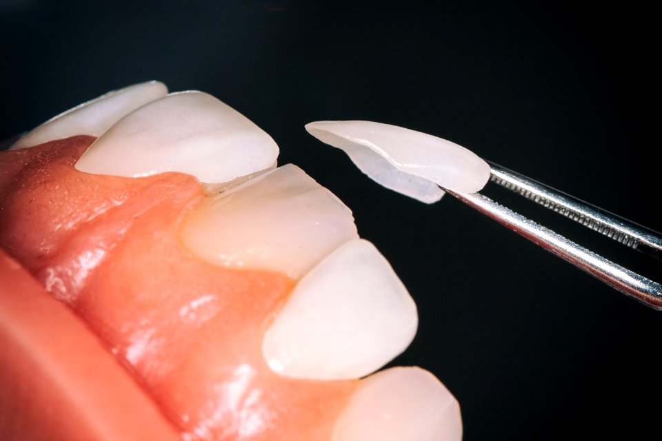 Dental veneers, Custommade, Porcelain