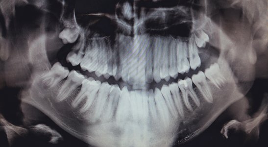 Teeth, Xray, Bones photo