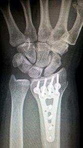 Fracture of radius wrist surgery