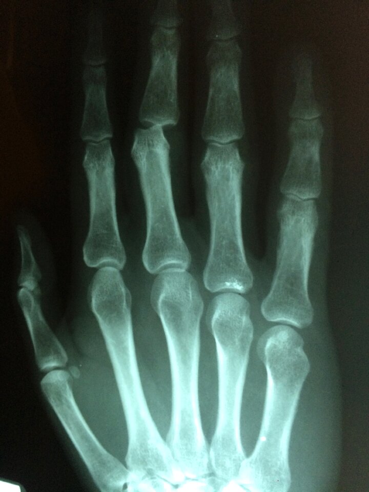 Injury pain patient