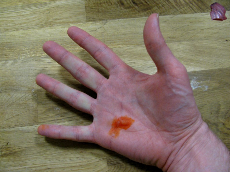 Stigmata Callous with Red Onion Peel 