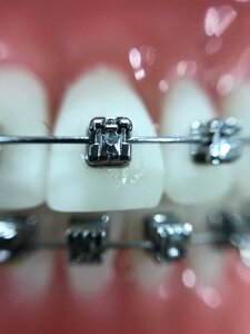 Zoom orthodontics iphone