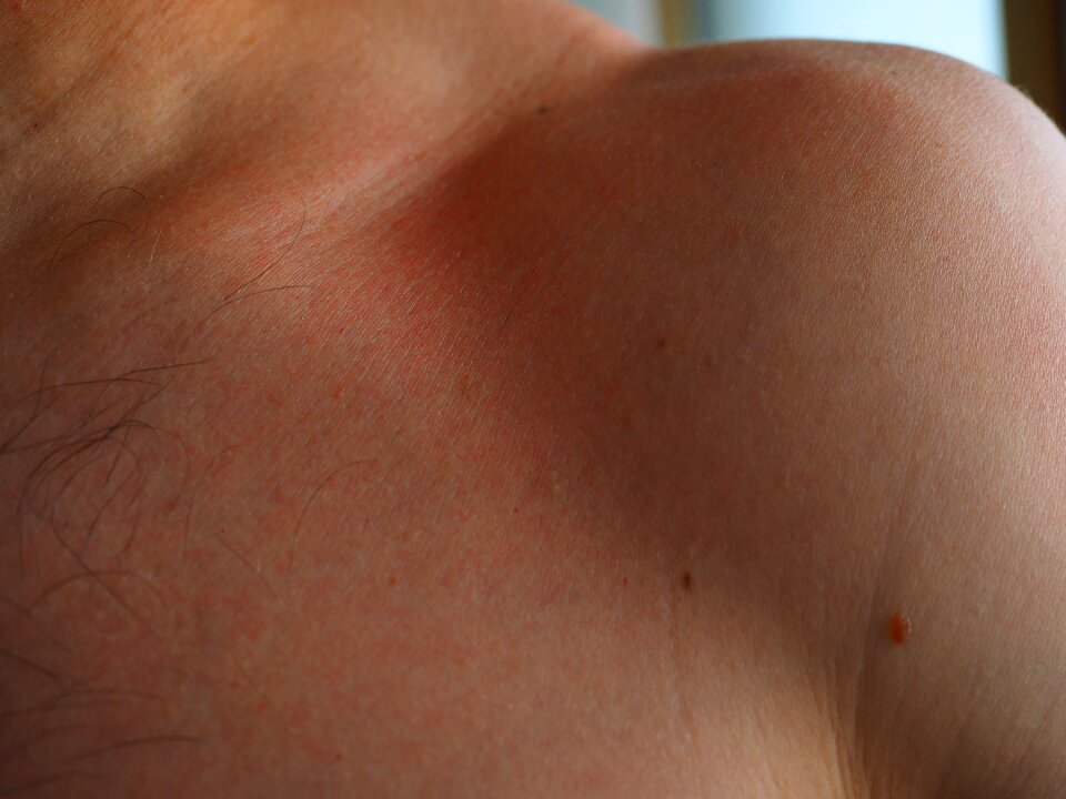 Flushed dermatology burned