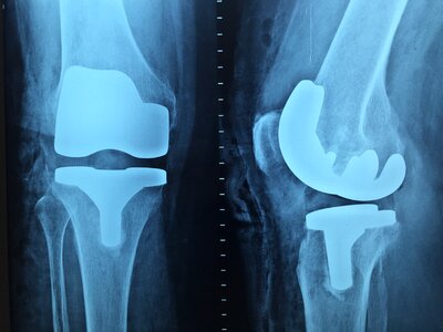 Orthopedics x-ray knee photo