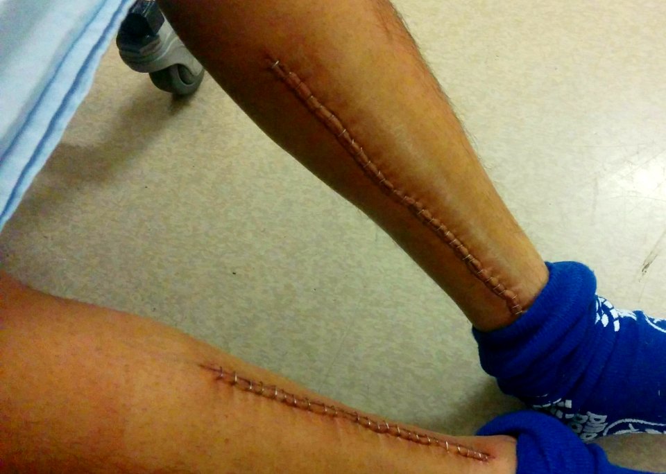 56 Staples (33 in Chest)