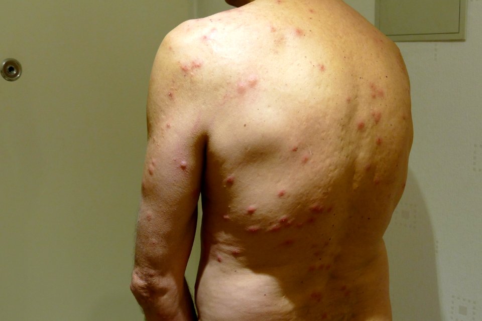 2015.11.26.192558_Cimex_lectularius_bites