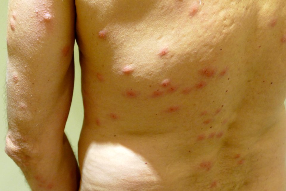 2015.11.26.192605Cimex_lectularius_bites