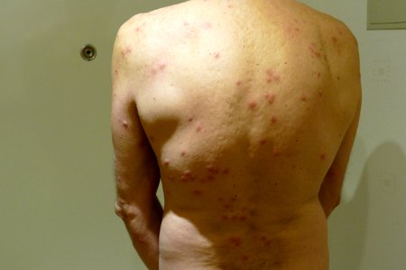2015.11.26.192551_Cimex_lectularius_bites