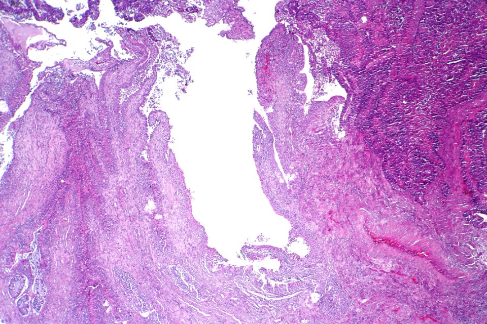 Adenocarcinoma_(intestinal_type)_of_the_urinary_bladder,_low_mag.1