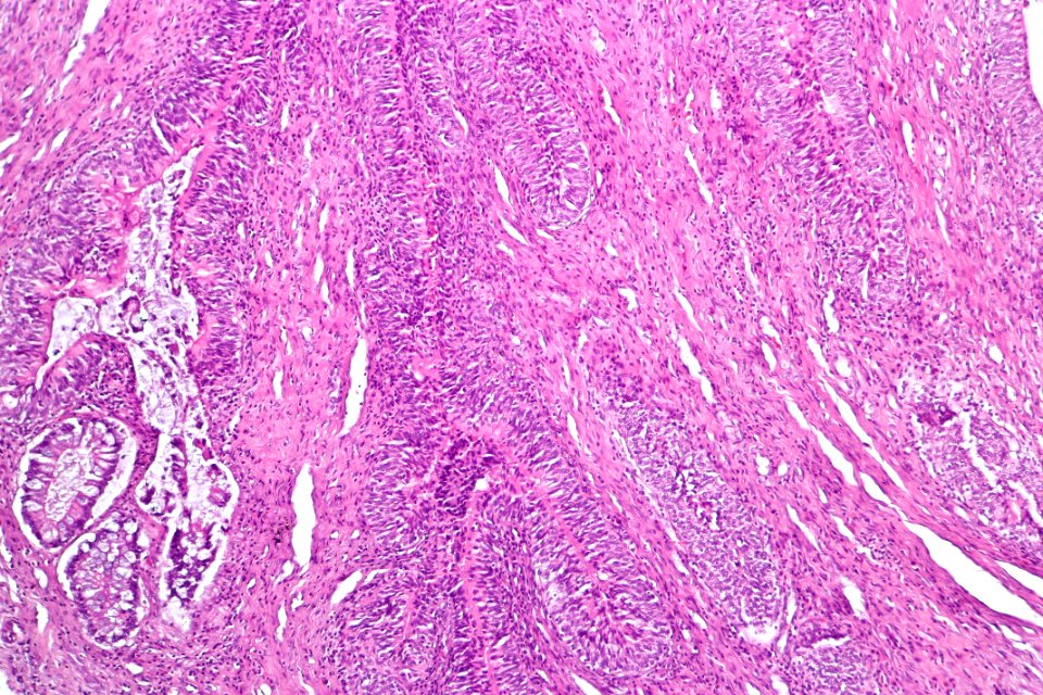Adenocarcinoma_(intestinal_type)_of_the_urinary_bladder,_intermed._mag.1