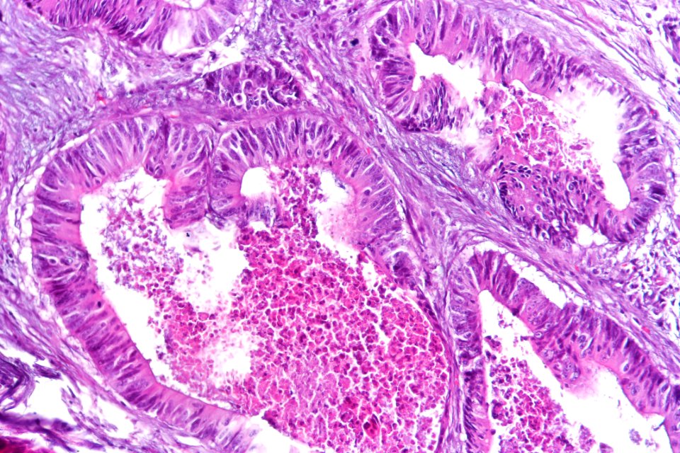 Adenocarcinoma_(intestinal_type)_of_the_urinary_bladder,_high_mag